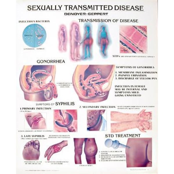 Charts/Posters, Sexually Transmitted Disease